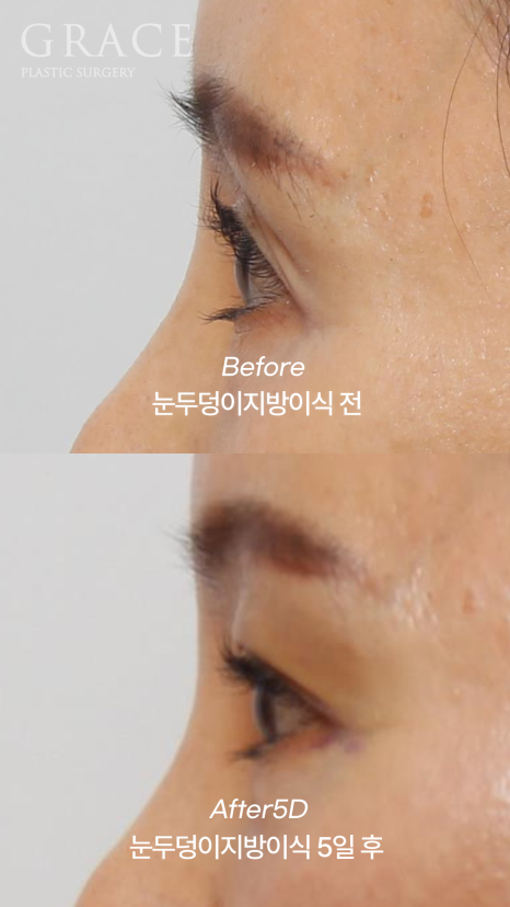 How Long Can Sunken Upper Eyelids Last Without Side Effects After Fat Grafting? image 7
