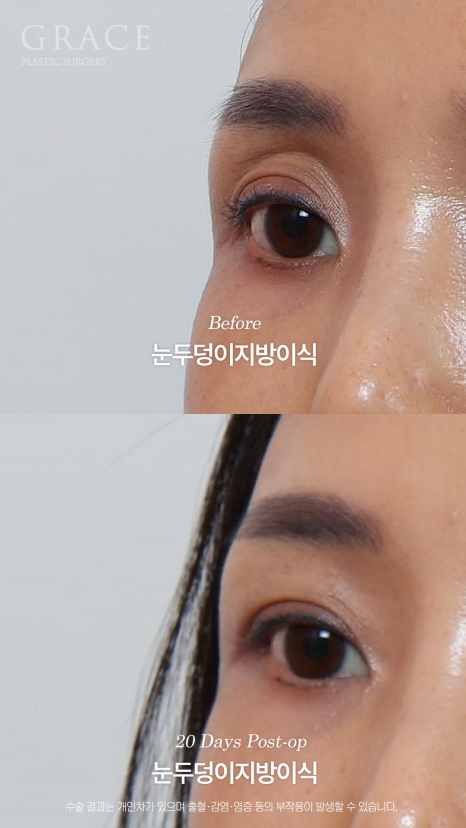 눈두덩이 지방이식 같은 내 지방인데 왜 울퉁불퉁해질까? 지방의 크기부터 다르니깐 관련 이미지 10