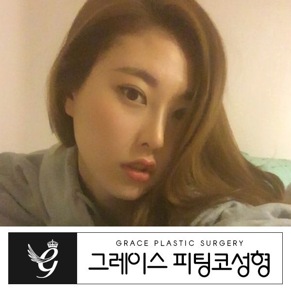 부드럽게 자유자재로 움직이는 코, 피팅코성형 관련 이미지 3