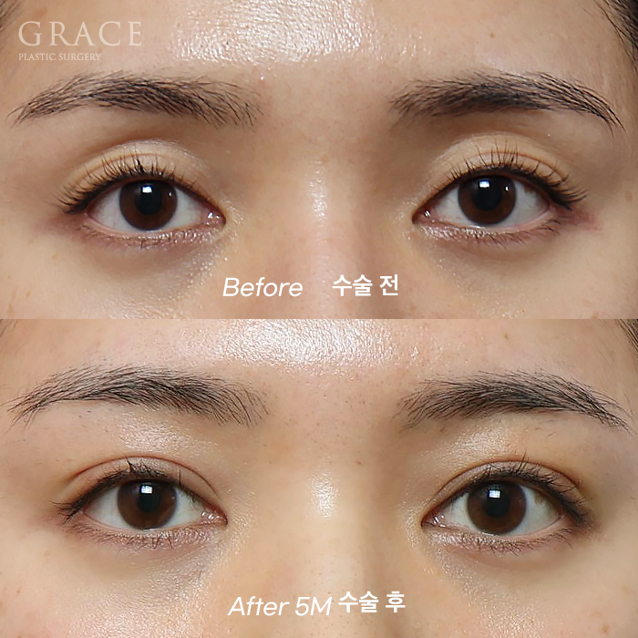 How to Fix a Sunken Eye Hollow: Upper Eyelid Fat Grafting + Ptosis Correction image 1