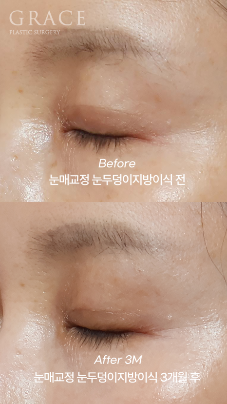 눈꺼풀 지방이식 생착률이 관건이라고? 1개월 회복의 과정 관련 이미지 6