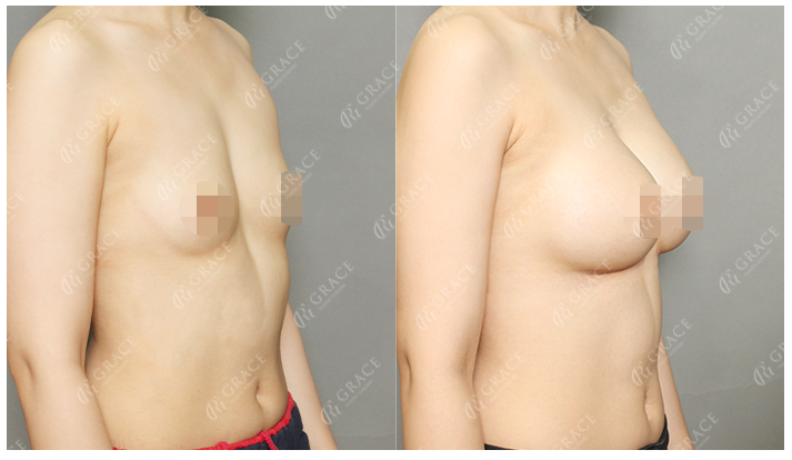 How Should You Choose a Good Breast Augmentation Clinic? image 2