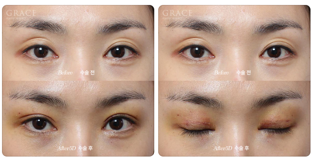 After eyelid fat grafting, do scars remain when you close your eyes? One week later... is this a failure? image 2