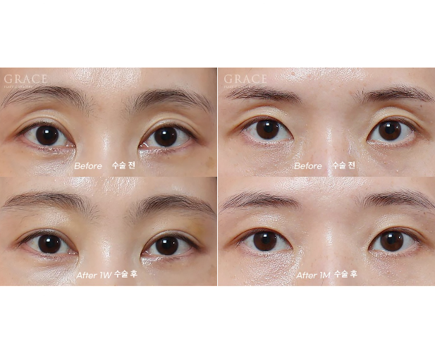Recovery Timeline Before and After Eyelid Orbital Fat Grafting: 1 Week image 10