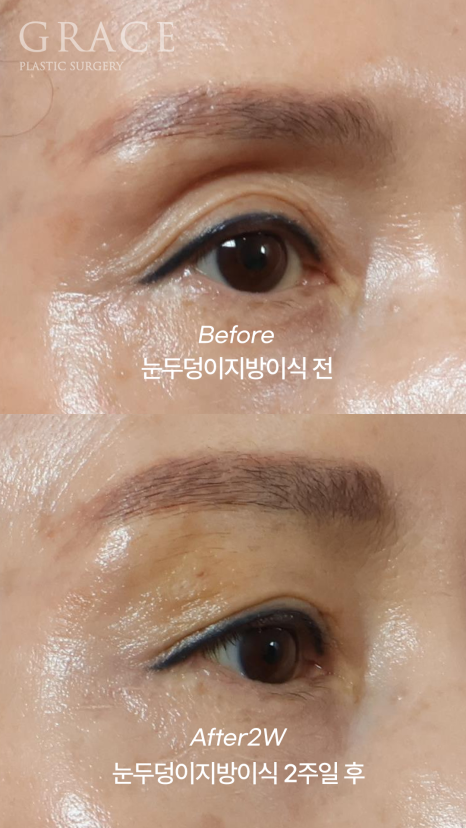 60대 중년 눈두덩이 안와지방이식 1cc 전후 관련 이미지 3