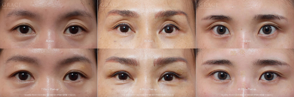 Looking into the Cost of Upper Eyelid Fat Grafting? What Really Matters Is More Than the Price..... image 1