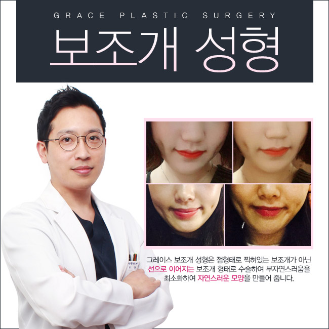 그레이스성형외과에서 보조개수술가격 알아보자! 관련 이미지 7
