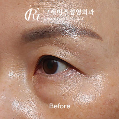 A Complete Guide to the Best Combination of Midlife Eye Surgery, from Under-Eye Fat Repositioning Costs to an I-Hole Filler Alternative image 4
