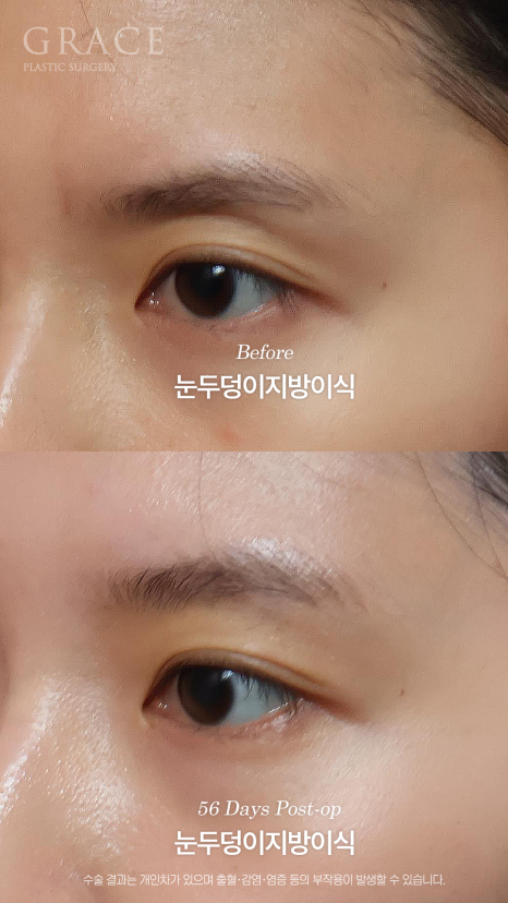 가을 되니 유독 퀭해 보이는 눈가 걱정? 눈두덩이 지방이식 56일차 관련 이미지 4