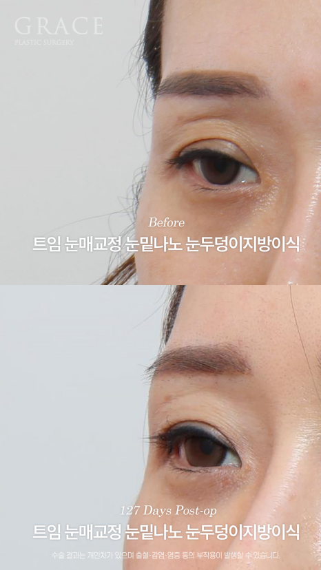 20년 전 쌍꺼풀 수술 겹쌍꺼풀에 눈두덩이 꺼짐까지? 아이홀 지방이식 재수 관련 이미지 7