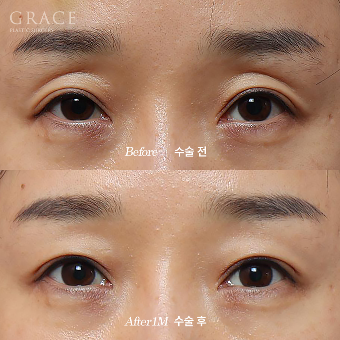 눈성형 부작용 후 재수술 안검하수 교정과 눈두덩이지방이식 1개월 경과 관련 이미지 1