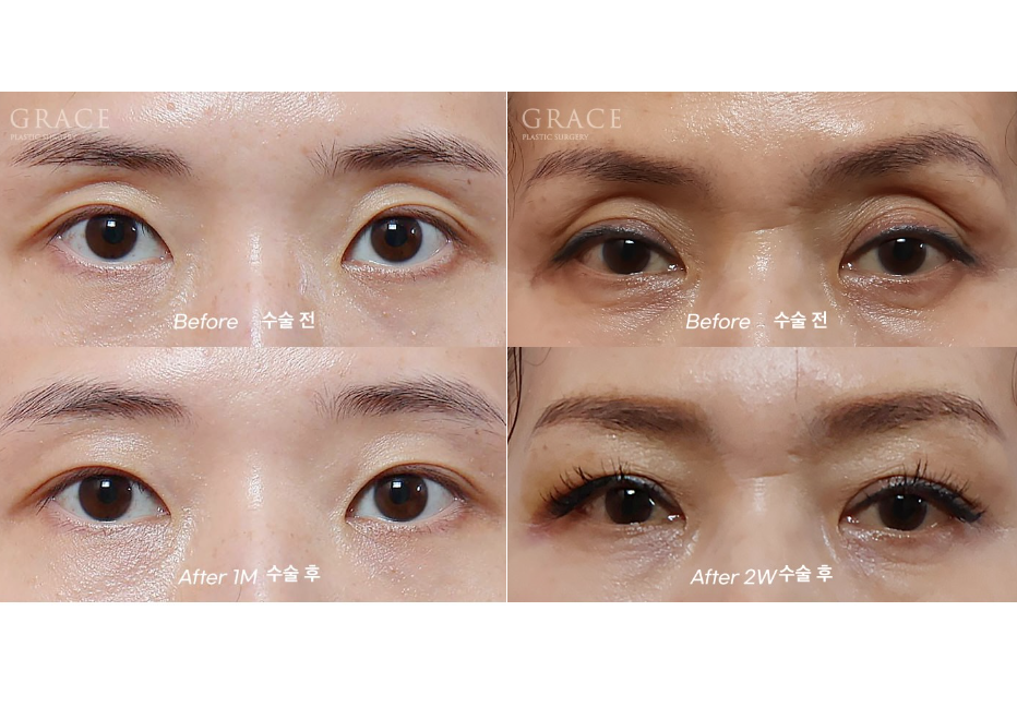 꺼진 눈두덩이 지방이식 잘하는 곳 유명한 이유가 있습니다. (칼럼) 관련 이미지 5