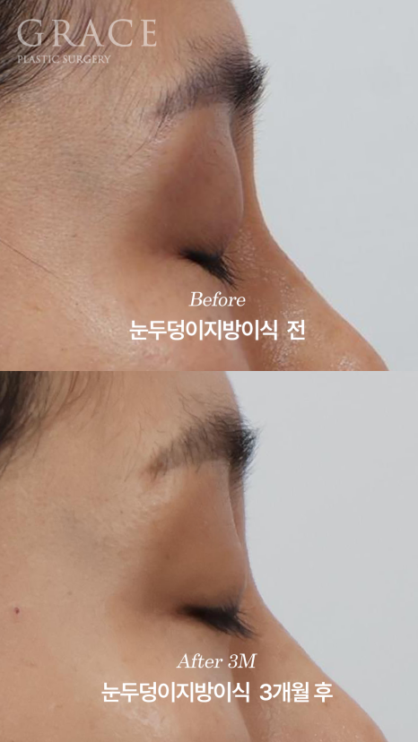 안와지방 주입 &middot; 눈두덩이지방이식 (1cc / 0.9cc) 관련 이미지 10