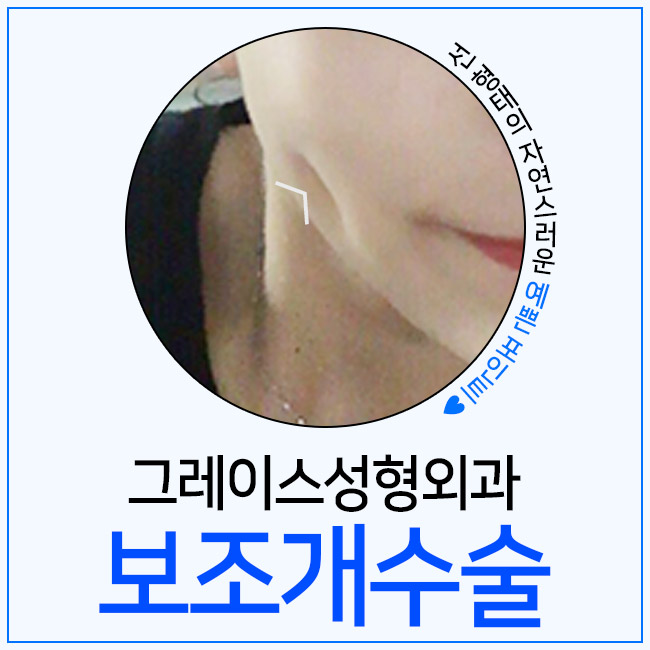 놀라운 변화 보조개수술후기를 만나보세요 관련 이미지 2