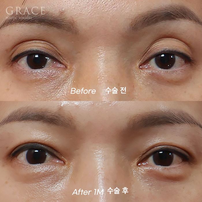Is Eyelid Fat Grafting in Your 40s Required to Include Ptosis Correction? It Depends on Your Eye Condition image 1