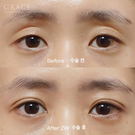 Why Choose Upper Eyelid Fat Grafting Instead of Eye-Hollow Filler? image 12