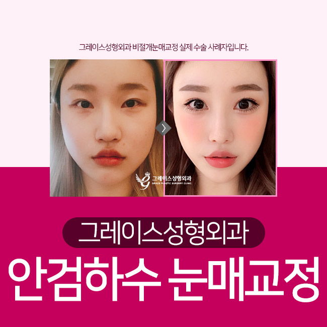 안검하수눈매교정, 또렷한 눈매로! 관련 이미지 4