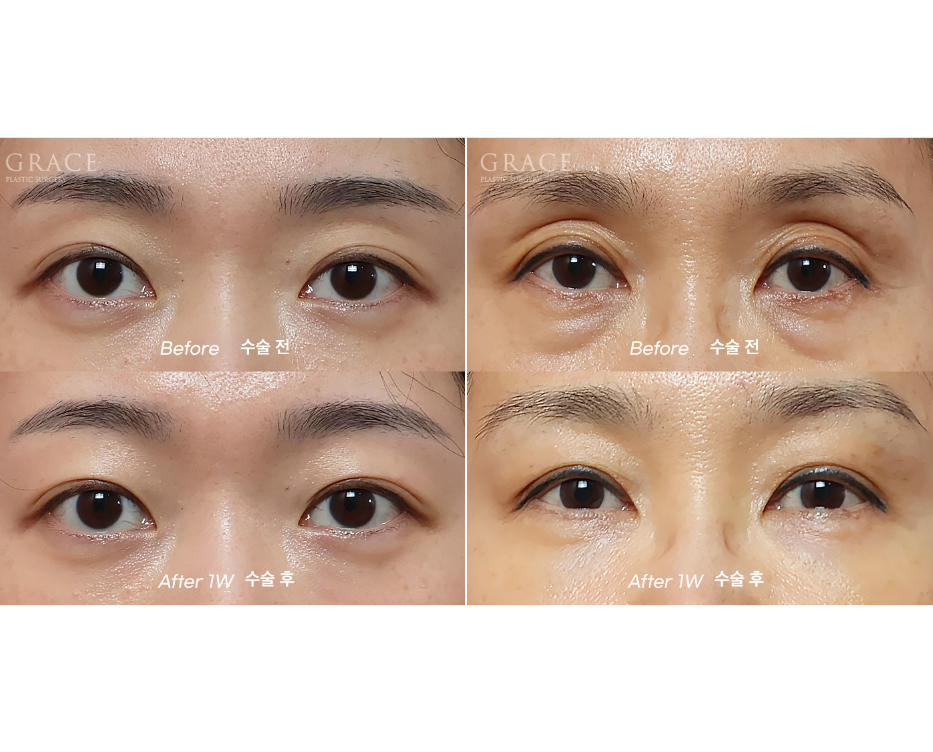 Grace Plastic Surgery Sunken Eye Hollows Upper Eyelid Fat Grafting image 1