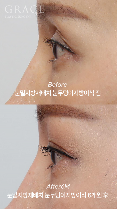 Eye Surgery for People in Their 50s That Reduces Time, Cost, and Recovery: Upper Eyelid Fat Grafting & Under-Eye Fat Repositioning image 1