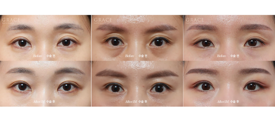 If You’re Curious About Eyelid Fat Grafting Reviews, Costs, Prices, and Side Effects image 1