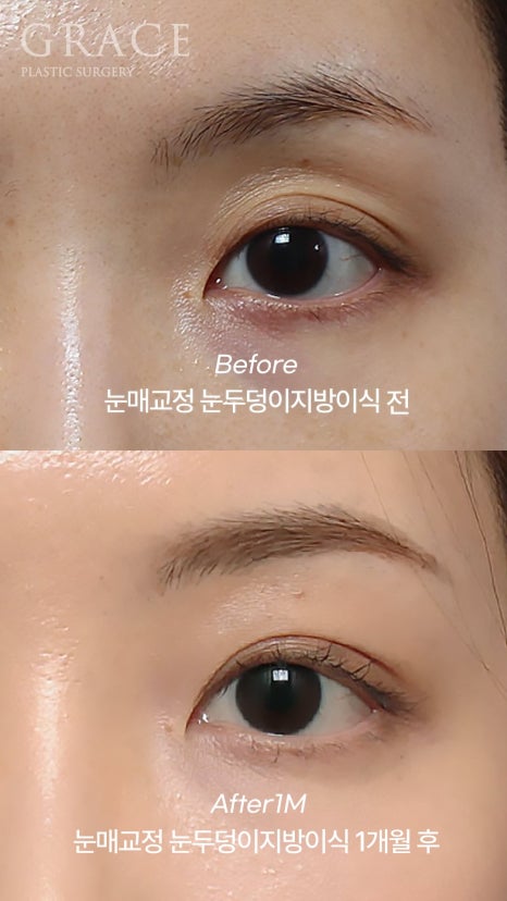 Eyebrow Hollow Fat Grafting Before and After Comparison – Gently Filling Sunken Eyes image 19