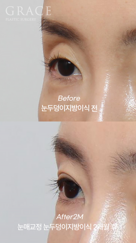 눈두덩이 지방이식 걱정만 덜기 관련 이미지 8