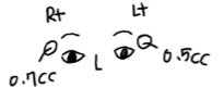 Side Effects of Eyelid Fat Grafting? One-Month Engraftment Period When Eyelid Correction Is Performed image 6
