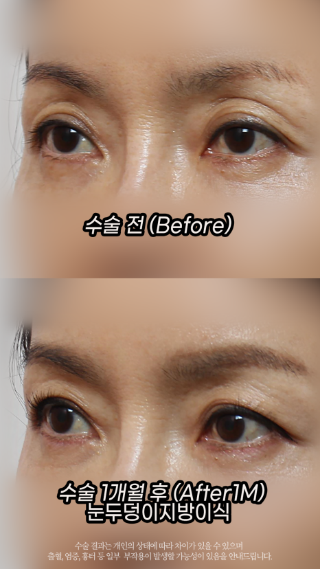 A Story About the Longevity of Eyelid (Eye Hole) Fat Grafting by Grace Plastic Surgery image 2