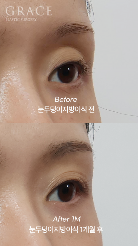 돌출눈·눈위 꺼짐으로 고생하는 사람이라면? 관련 이미지 5