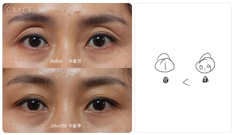 The Real Cause of Side Effects from Upper Eyelid Fat Grafting: the Injection Layer (Orbicularis Oculi Muscle & Orbital Fat) image 4