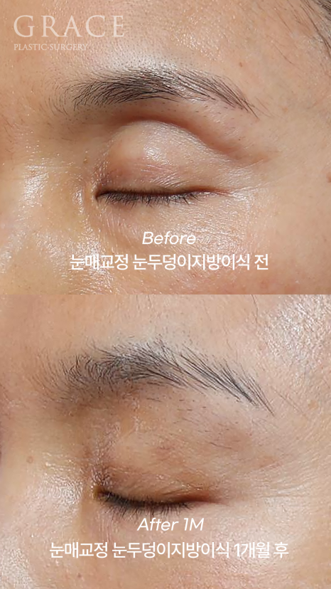 꺼진 아이홀 지방이식, 울퉁불퉁 부작용 오해 바로잡기 관련 이미지 9