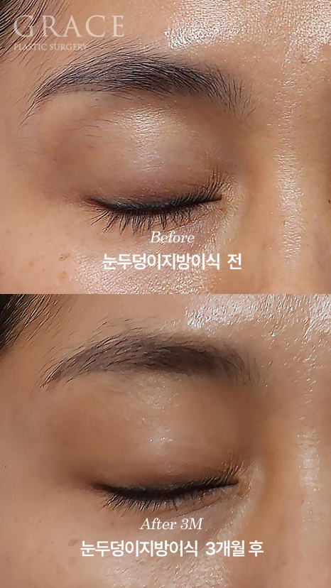 안와지방 주입 &middot; 눈두덩이지방이식 (1cc / 0.9cc) 관련 이미지 2