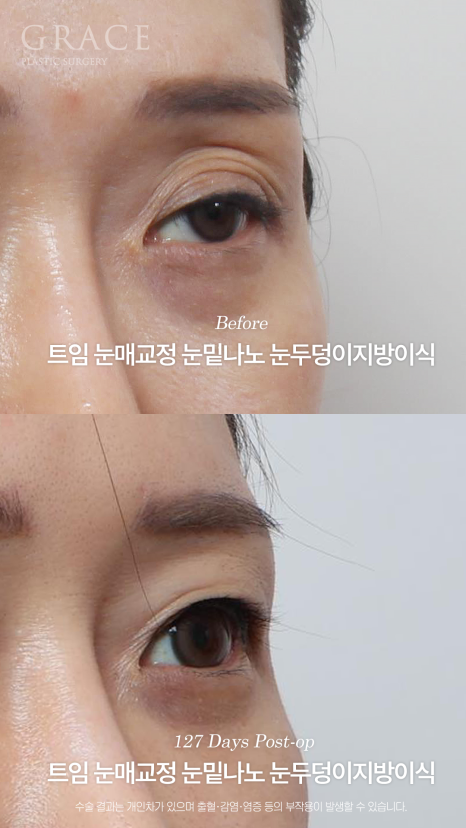 20년 전 쌍꺼풀 수술 겹쌍꺼풀에 눈두덩이 꺼짐까지? 아이홀 지방이식 재수 관련 이미지 5