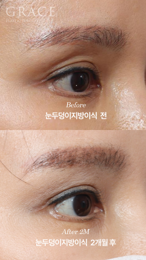 Will Swelling After Eyelid Fat Grafting Last a Long Time... Is It Really True? image 8