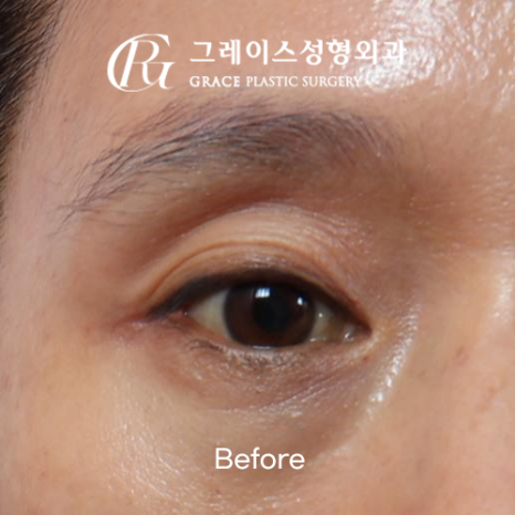 꺼진 눈 성형 1주일 붓기 보정 없이 솔직하게 보여드립니다 관련 이미지 1