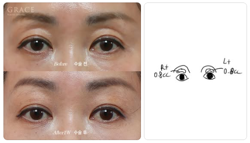 Complications from Sunken Eyelid Fat Grafting? The Injection Location Determines the Result image 6