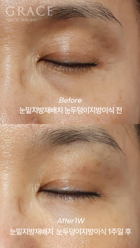아이홀 꺼짐과 눈밑 지방을 동시에 해결하고 싶다면 관련 이미지 3