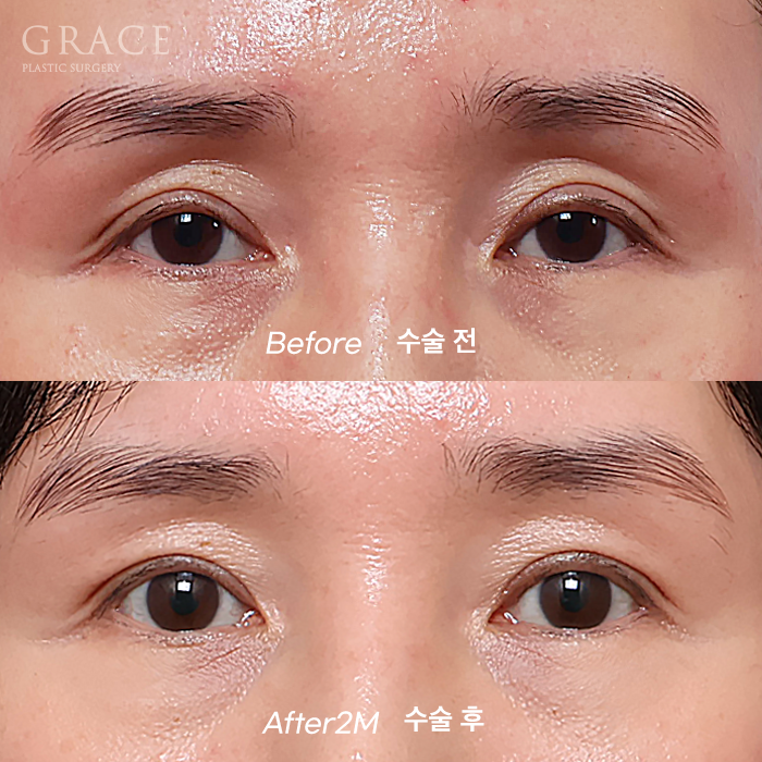 Why Do Hollow Eyelids Occur, and How Can They Be Naturally Improved? (Research Notes from a Doctor Performing Eyelid Fat Grafting) image 1