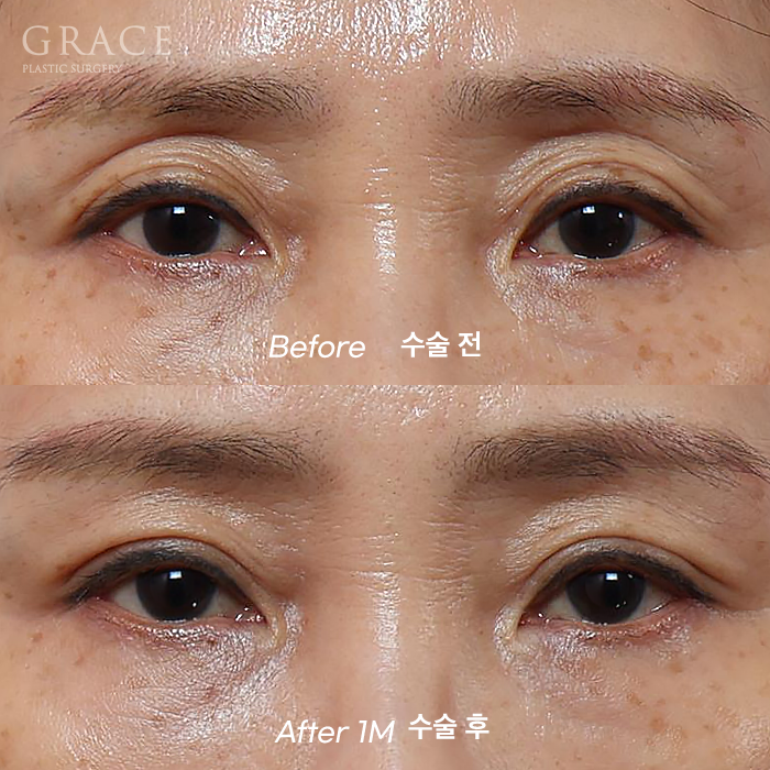 Understanding the Difference Between Forehead Fat Grafting (Eye Hollow Fat Grafting) and Fillers image 9