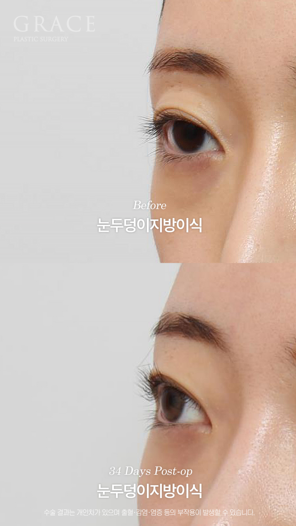 눈두덩이 지방이식이 필요한 경우 진료실에서는 무엇을 볼까요? 관련 이미지 7