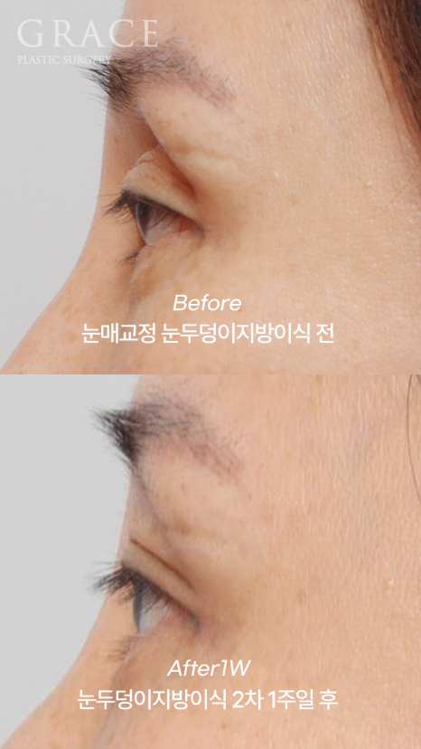눈두덩이지방이식 2차 이식(리터치) 마취&지방채취 부위 등 관련 이미지 5