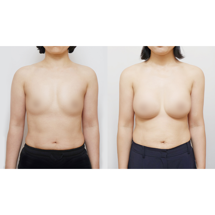Is Getting 360cc Motiva Implants All It Takes? The Real Difference Is Vertical Rearrangement image 1