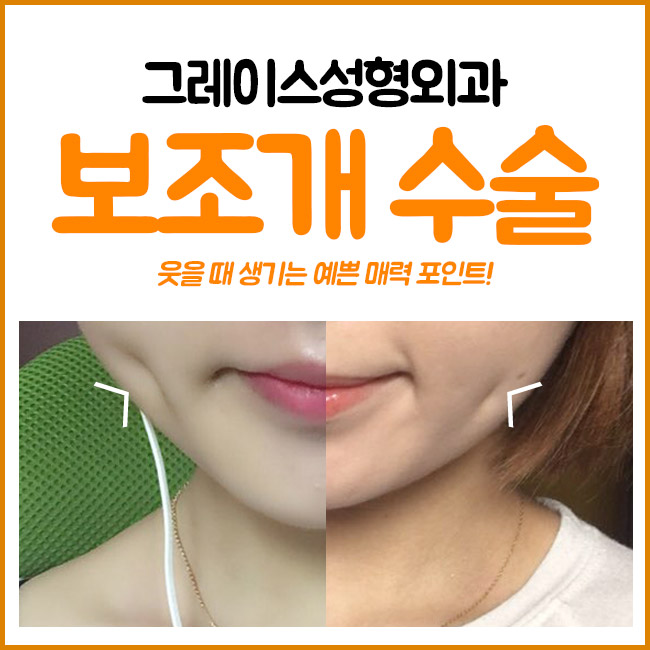 보조개수술 합리적인 가격과 매력적인 후기까지 관련 이미지 2
