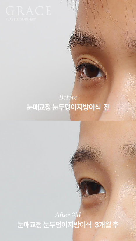 눈두덩이지방이식 붓기 언제 빠질까? 부작용&middot;유지기간까지 1주&middot;3개월&middot;6개월 변화 관련 이미지 4