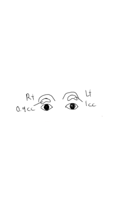 Eyelid Fat Grafting Bruising and Swelling Side Effects (Natural Eyelid Line After 5 Days) image 8
