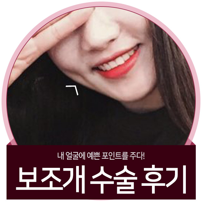 성공한 보조개수술후기를 찾고있다면? 이곳이 정답! 관련 이미지 1
