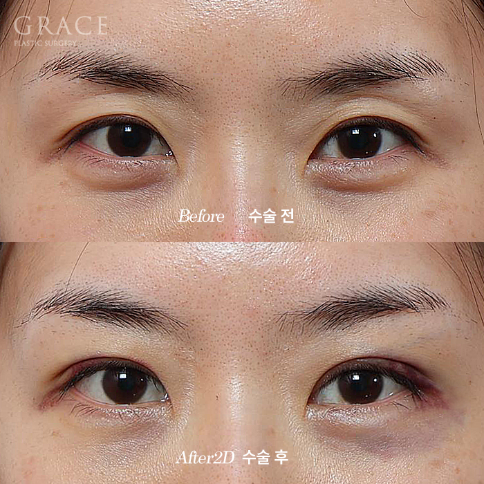 Why It’s Not Always Better Just Because Lower Eyelid Fat Grafting Is Cheap image 6