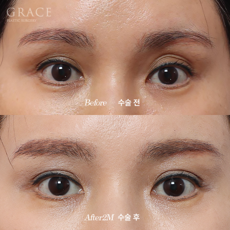 Will Swelling After Eyelid Fat Grafting Last a Long Time... Is It Really True? image 2