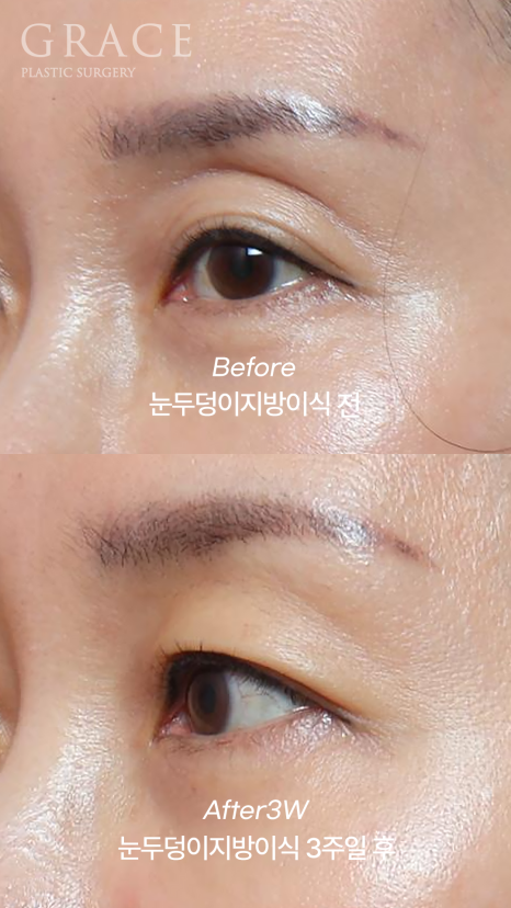Celebrities with Sunken Eye Hollows, Filler Issue? Upper Eyelid Fat Grafting image 2