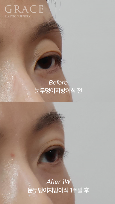 The Basis for a 94.5% Functional Improvement: Fat Grafting Technology That Fills in a Sunken Eye Hollow image 4